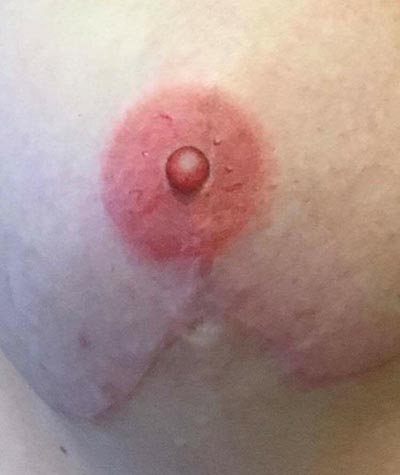 Areola/Nipple Breast Cancer Survivor