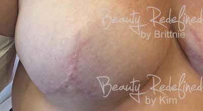 Areola/Nipple Breast Cancer Survivor Before