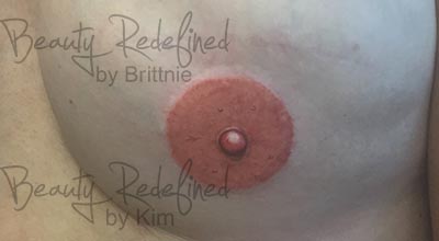 Areola/Nipple Breast Cancer Survivor After