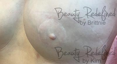 Areola/Nipple Breast Cancer Survivor Before