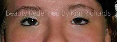 Fetal Alcohol Syndrome - Immediately After Eyeliner