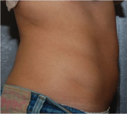 Female Circumferential Reduction After